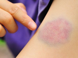 Mendadak Muncul Lebam Biru, Benarkah karena Dijilat Setan? Ini Faktanya