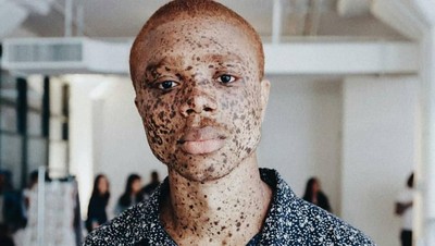 Potret Cantiknya Model dengan Bintik Hitam di Sekujur Tubuhnya