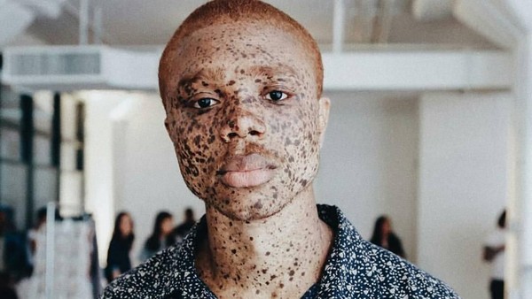 Potret Cantiknya Model dengan Bintik Hitam di Sekujur Tubuhnya