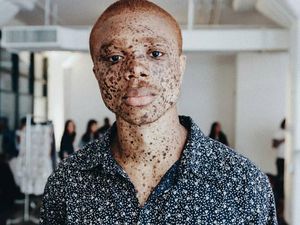 Potret Cantiknya Model dengan Bintik Hitam di Sekujur Tubuhnya