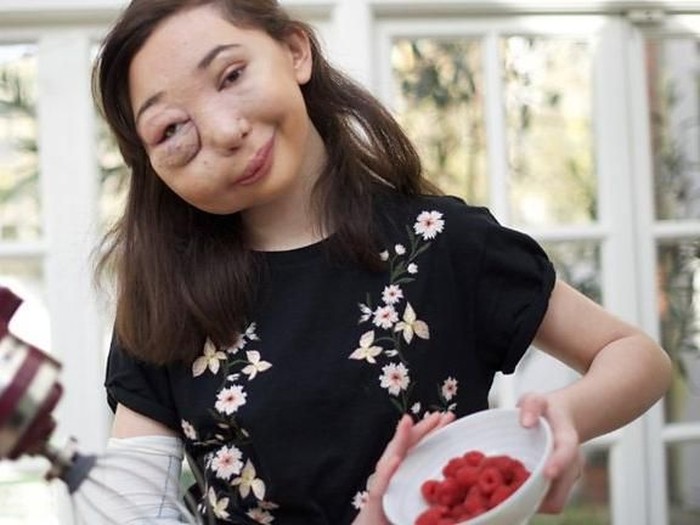 Bila serangan perdarahan terjadi, Nikki bisa mengeluarkan air mata darah. (Foto: BBC) Bila serangan perdarahan terjadi, Nikki bisa mengeluarkan air mata darah. (Foto: BBC)