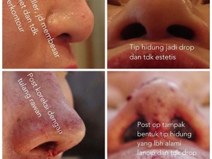 Suntik Filler Ngetren Lagi, Tompi Sebut Belasan Hidung Rusak Tiap Bulan