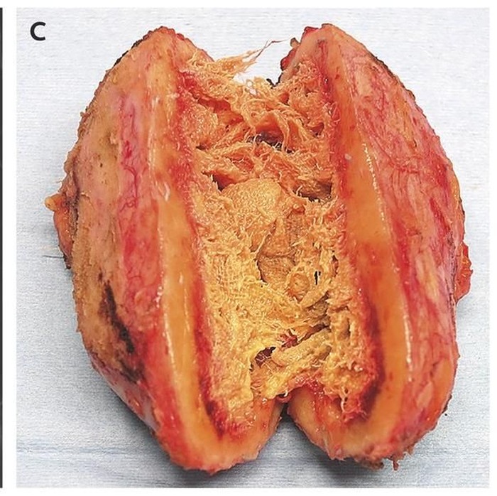 Spons yang sudah terbungkus oleh serat-serat tubuh. (Foto: The New England Journal of Medicine) Spons yang sudah terbungkus oleh serat-serat tubuh. (Foto: The New England Journal of Medicine)