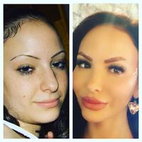 Penyesalan Wanita yang Pasang Implan di Bokong Senilai Rp 285 Juta