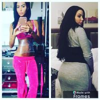 Penyesalan Wanita yang Pasang Implan di Bokong Senilai Rp 285 Juta