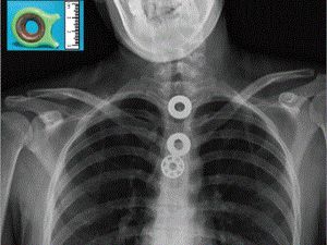 Foto Rontgen Ini Tunjukkan yang Terjadi Bila Menelan Fidget Spinner