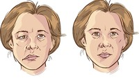 Tak bisa menggerakkan sebagian wajah atau sekaligus satu sisi tubuh tanpa disertai gejala lain merupakan tanda dari Bells palsy. Sebuah kondisi saat sesuatu (misalnya virus) menekan saraf yang mengontrol otot di wajah atau membuatnya bengkak. Biasanya tidak serius dan bisa kembali normal dalam 3-6 bulan. Foto: ilustrasi/thinkstock