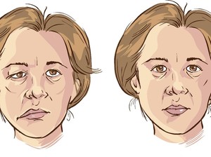 Bells Palsy, Apa Penyebab dan Bagaimana Cara Mengobatinya?