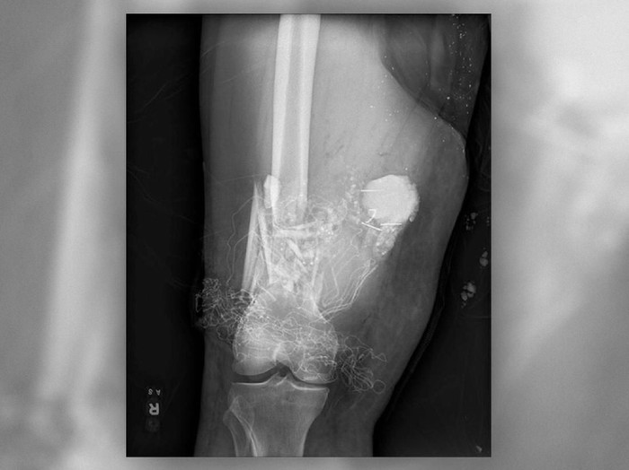Rontgen bagian petasan yang tertanam di kaki kanan seorang pria. (Foto: Live Science/The Journal of Emergency Medicine) Rontgen bagian petasan yang tertanam di kaki kanan seorang pria. (Foto: Live Science/The Journal of Emergency Medicine)