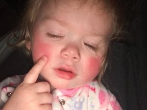 Fakta di Balik Aquagenic Urticaria, Alergi Air yang Langka