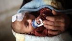Foto: Bayi Karim Bermata Satu yang Sembunyi karena Serangan Assad