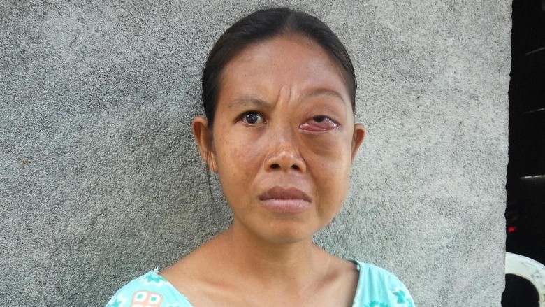 Tak Ada Biaya, Yuliastri Sudah 4 Tahun Hidup dengan Kanker Mata Tak Ada Biaya, Yuliastri Sudah 4 Tahun Hidup dengan Kanker Mata
