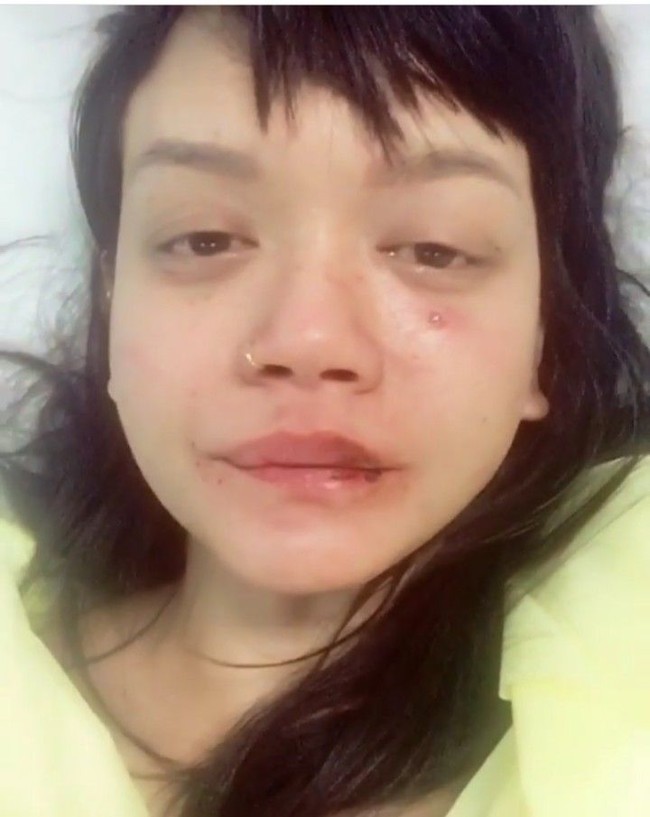 Dylan Sada menceritakan kekerasan fisik yang dialaminya lewat akun Instagramnya. Pada video yang dipostingnya itu, Dylan Sada terlihat tengah terbaring di rumah sakit dengan wajah penuh luka memar. Tak hanya itu, Dylan Sada juga menunjukkan kerontokkan rambut yang dialaminya karena mengalami kekerasan fisik dari sang kekasih. Foto: Instagram