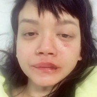 Dylan Sada menceritakan kekerasan fisik yang dialaminya lewat akun Instagramnya. Pada video yang dipostingnya itu, Dylan Sada terlihat tengah terbaring di rumah sakit dengan wajah penuh luka memar. Tak hanya itu, Dylan Sada juga menunjukkan kerontokkan rambut yang dialaminya karena mengalami kekerasan fisik dari sang kekasih. Foto: Instagram