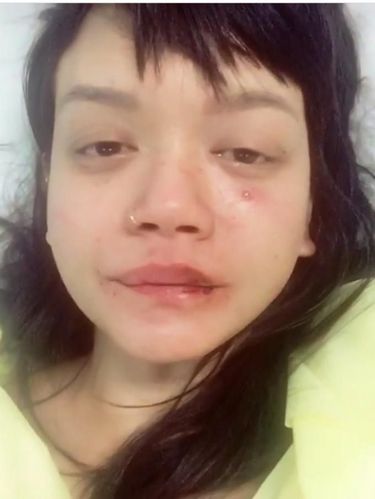 Dylan Sada pernah mengunggah foto saat jadi korban kekerasan kekasihnya.