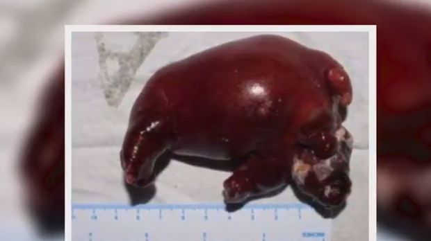 Kasus langka Fetus in fetu