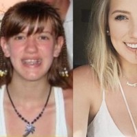 Pakai kawat gigi dan belum bisa berpose cantik ketika berusia 12 tahun kini di usia 22 tahun dia menjadi wanita yang super cantik. Dengan rambut pirang tanpa kawat gigi, wanita ini tampil memukau.  Foto: dok. Reddit