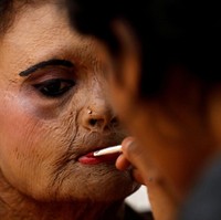 Setiap tahunnya, dari 1.500 kasus serangan air keras yang terjadi di dunia, 2/3 dari kasus itu dialami wanita India. Dan yang lebih memprihatinkan, hanya beberapa korban yang melaporkan kasus penyerangan ini karena takut atau diancam oleh sang penyerang. Foto: Dok. AFP, Reuters