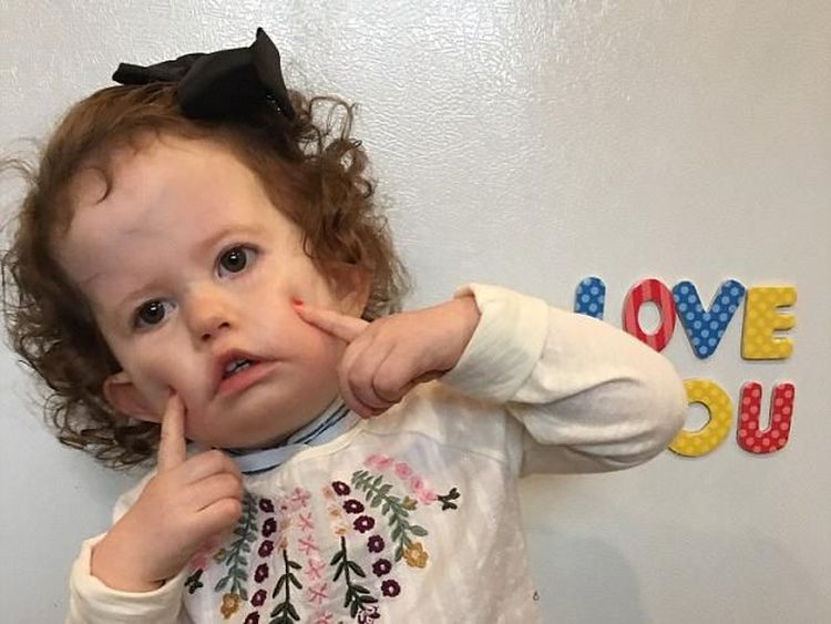Idap Penyakit Saraf Langka, Bayi Ini Butuh Rp 1,7 M untuk Bisa Senyum