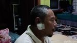 Perban di Rahang Abdul yang Ditusuk Saat Salat Subuh di Masjid