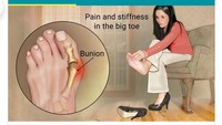 Ilustrasi ini rasanya bikin kamu ingin bilang Makanya jangan pakai sepatu hak tinggi biar nggak kena bunion. Benar juga sih, tapi kenapa harus hak tinggi? Hihi.. (Foto: Google Search) 