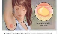 Memang menunjukkan abses sih, tapi kesannya jadi seperti orang mencium bau ketiak nih: Mungkin besok ganti deodoran saja ya? (Foto: Google Search) 