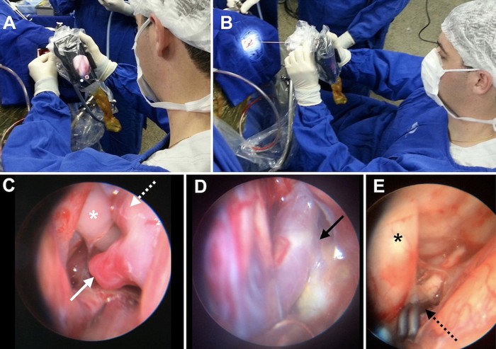Ketika dokter menggunakan iPhone untuk alat endoskopi. (Foto: American Association of Neurological Surgeons) Ketika dokter menggunakan iPhone untuk alat endoskopi. (Foto: American Association of Neurological Surgeons)