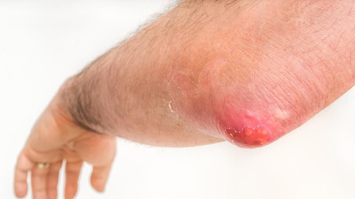 7 Pengobatan Alami agar Bisul Cepat Kempes dan Tidak Sakit