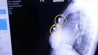 Proyektil peluru bersarang di tubuh Atikah selama lima hari. Benda tajam itu tak tembus bagian organ dalam. Tim medis RSUD Syamsudin Sukabumi melaksanakan tindakan bedah untuk mengeluarkan dua benda yang nyangkut tepat di area dada kiri Atikah. (Foto: istimewa)