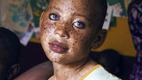 Ini adalah Grace Esther, gadis asal Kamerun yang viral di sosial media. Ia juga terkena sindrom waardenburg. (Foto: Instagram/presidentkagiso)