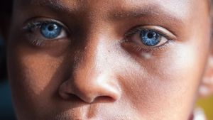 Aww.. Mata Biru Menyala Penyandang Sindrom Waardenburg