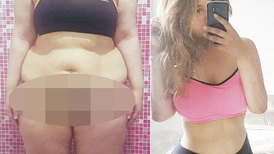 Gagal Jaga Berat Pasca Diet Keto, Si Cantik Ini Pangkas Lambungnya