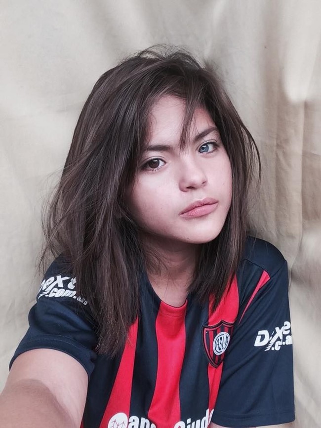 Pada dunia medis, kasus yang dialami oleh remaja asal Bacolod, Filipina ini disebut sebagai kelainan pada mata yang sering dianggap heterochromia, yakni memiliki warna mata yang berbeda antara satu dengan yang lainnya. Foto: Facebook