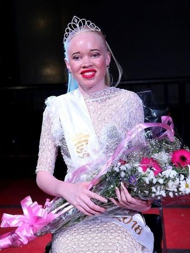 Zimbabwe Gelar Kontes Kecantikan untuk Wanita Albino