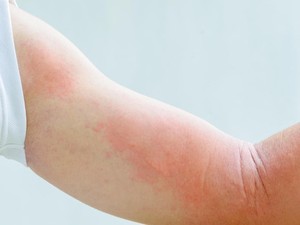 Disebut Alergi Kacang, Gadis Ini Hampir Meninggal Karena Infeksi Langka