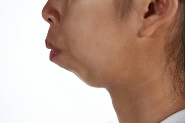 Wijitpraphorn Punbu atau yang lebih dikenal dengan panggilan Fon terlahir tanpa memiliki dagu. Hal itu mempengaruhi bentuk di area dagu dan giginya. Foto: Dok. Instagram, Istimewa