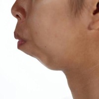 Wijitpraphorn Punbu atau yang lebih dikenal dengan panggilan Fon terlahir tanpa memiliki dagu. Hal itu mempengaruhi bentuk di area dagu dan giginya. Foto: Dok. Instagram, Istimewa