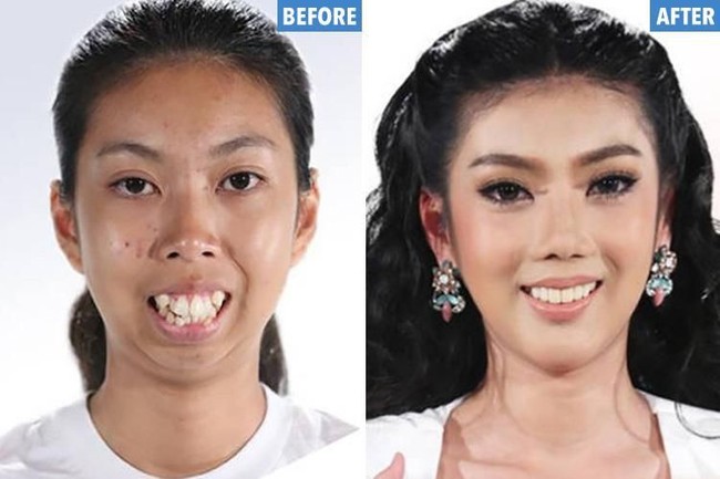 Wanita asal Thailand ini bertransformasi jadi gadis cantik jelita. Dulunya, teman-temannya kerap mengolok fisiknya karena bagian wajahnya yang tidak simetris.  Foto: Dok. Instagram, Istimewa