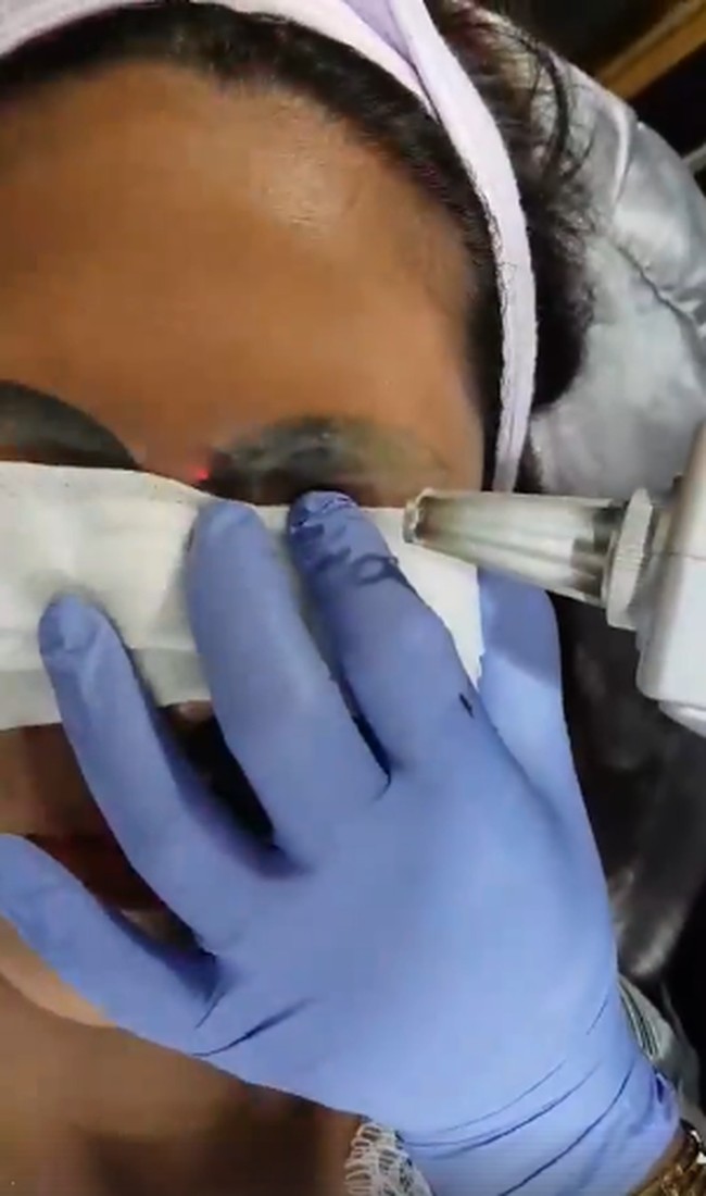 Dalam postingan di Facebook, Vilailak melakukan perawatan laser di alis Kanyarat untuk menghilangkan tinta tato di alisnya. Perawatan ini tak bisa sekali.  Foto: dok. Facebook