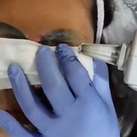 Dalam postingan di Facebook, Vilailak melakukan perawatan laser di alis Kanyarat untuk menghilangkan tinta tato di alisnya. Perawatan ini tak bisa sekali.  Foto: dok. Facebook