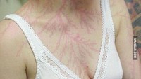 Nah bagi mereka yang bisa selamat, ia bisa mengalami luka khas ketika petir mengalir di dalam dirinya. Luka yang tampak seperti akar pohon ini disebut sebagai luka lichtenberg. (Foto: 9gag)