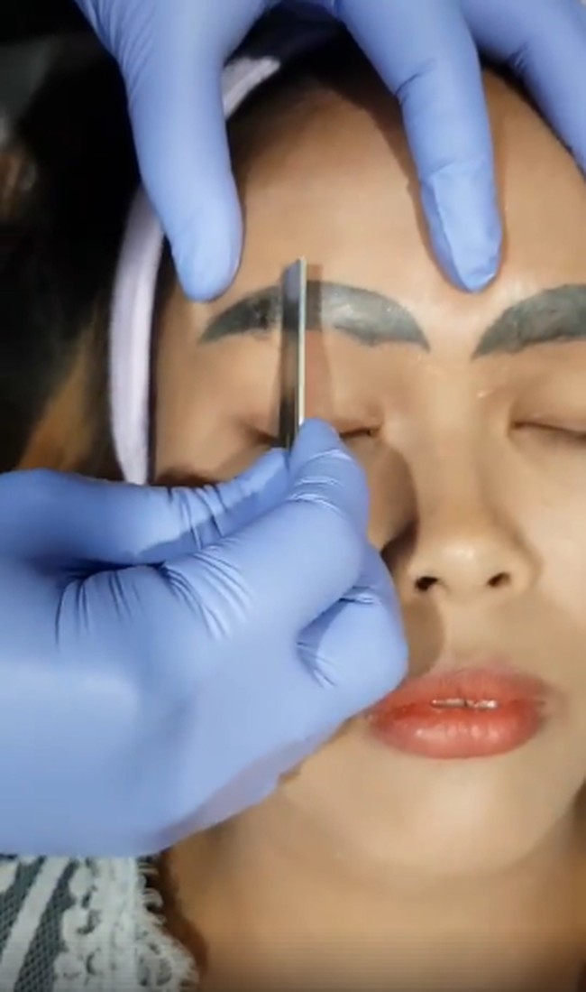 Butuh waktu berkali-kali untuk menghilangkan tato alisnya. Pertama-tama rambut alis dikerok terlebih dahulu agar sinar laser bisa langsung menembus kulit.  Foto: dok. Facebook