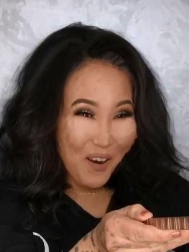Lahir dengan Tahi Lalat Sewajah, Transformasi Wanita Ini Bikin Pangling