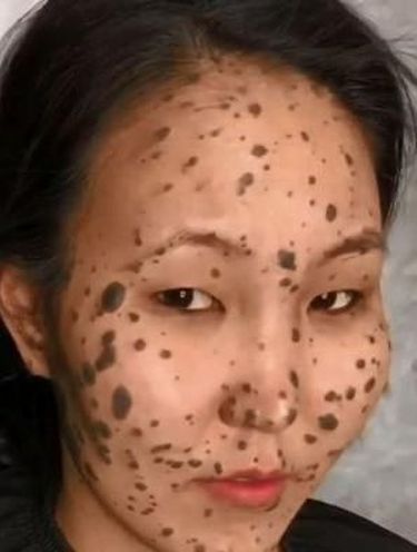 Lahir dengan Tahi Lalat Sewajah, Transformasi Wanita Ini Bikin Pangling