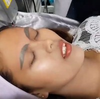 Vilailak mengaku bahwa biaya laser untuk menghilangkan tato alis tersebut tidak murah. Biayanya sekitar US$ 960 hingga US$ 1600. Namun Vilailak merasa bahagia bisa memberikan perawatan secara gratis untuk Kanyarat.  Foto: dok. Facebook