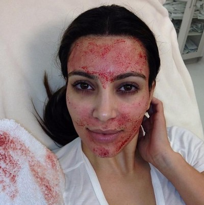 Kim Kardashian perawatan Vampire Facial