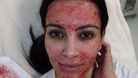 3 Wanita Terinfeksi HIV Setelah Vampire Facial di Spa Tidak Berlisensi
