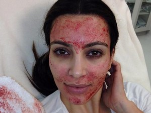 Tren Facial Vampire yang Dipopulerkan Kim Kardashian Ternyata Berisiko