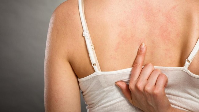 Berbagai Tips Menghilangkan Eksim Secara Natural (2)