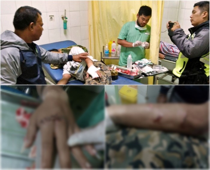 Diserang Pemuda Mabuk di Sukabumi, Jari Yatna Nyaris Putus
